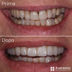 aversano-designer-del-sorriso-lavoro-su-arcata-superiore